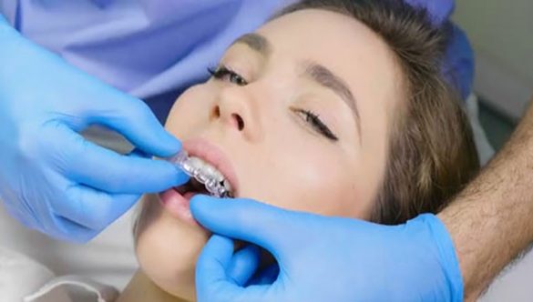 What is Invisalign?
