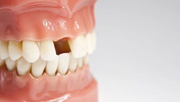 Missing Teeth & Replacements