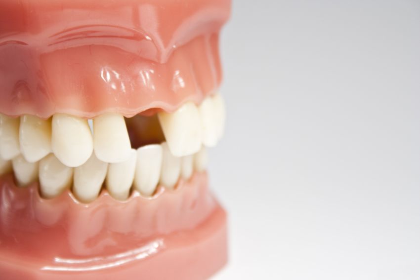 Missing Teeth & Replacements