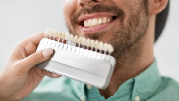 Are Veneers Permanent?