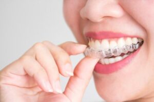 Benefits of Invisalign Braces