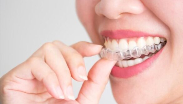 Benefits of Invisalign Braces