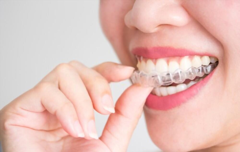 Benefits of Invisalign Braces
