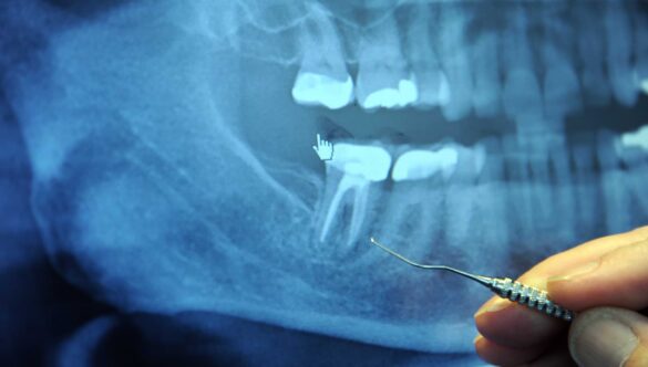 What Is The Difference Between Root Canal Treatment and Tooth Extraction?
