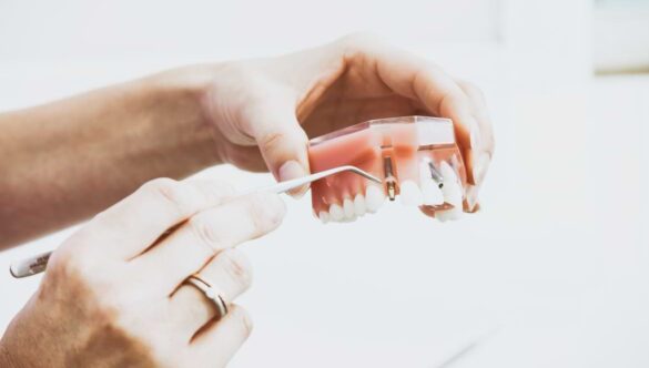 What Are the Advantages of All-On-4 Dental Implants?