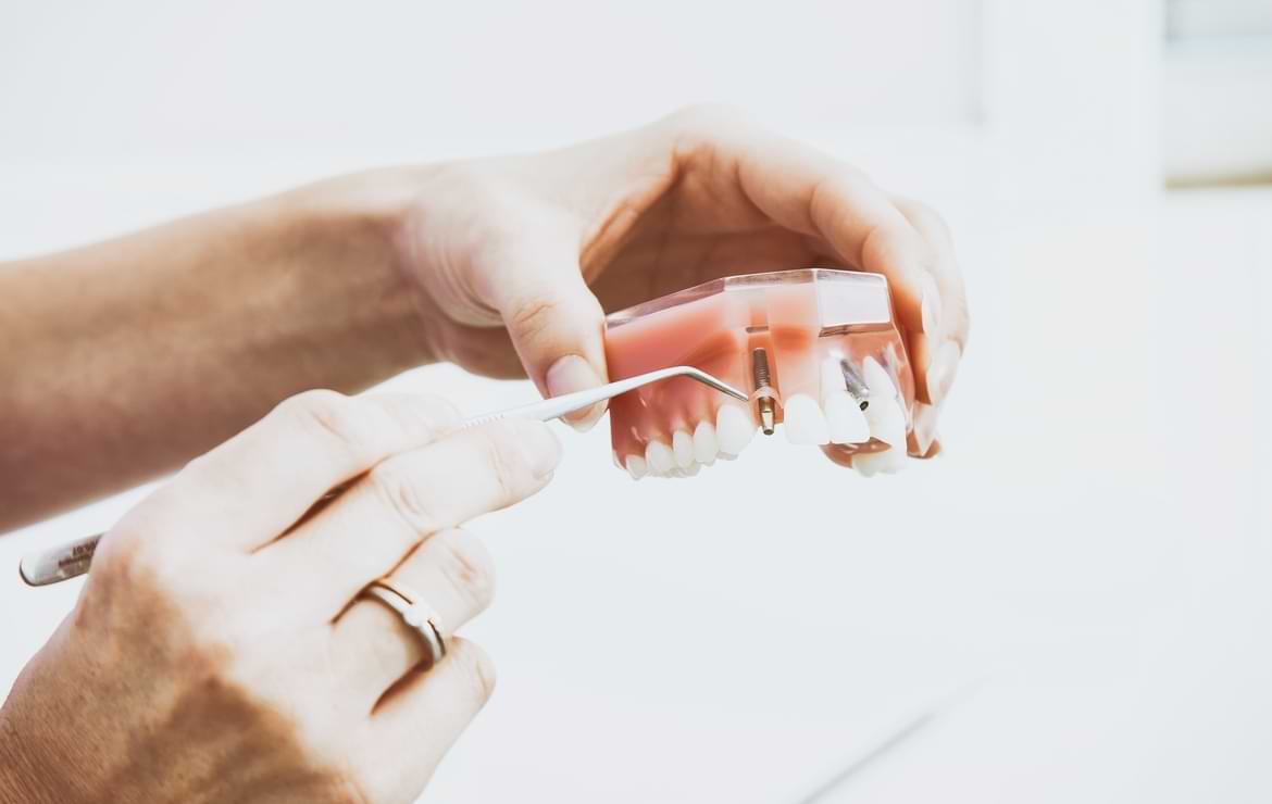 What Are the Advantages of All-On-4 Dental Implants?