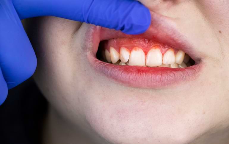 What Is Gingivitis & What Can You Do?