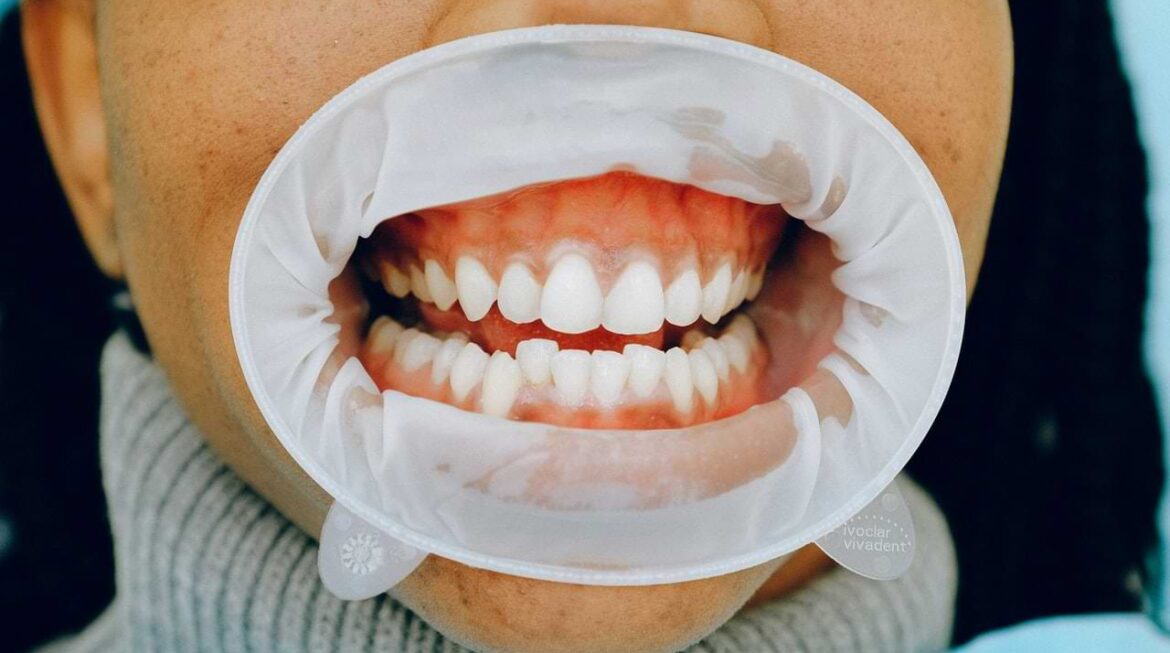 Receding Gums Treatment: What You Need to Know