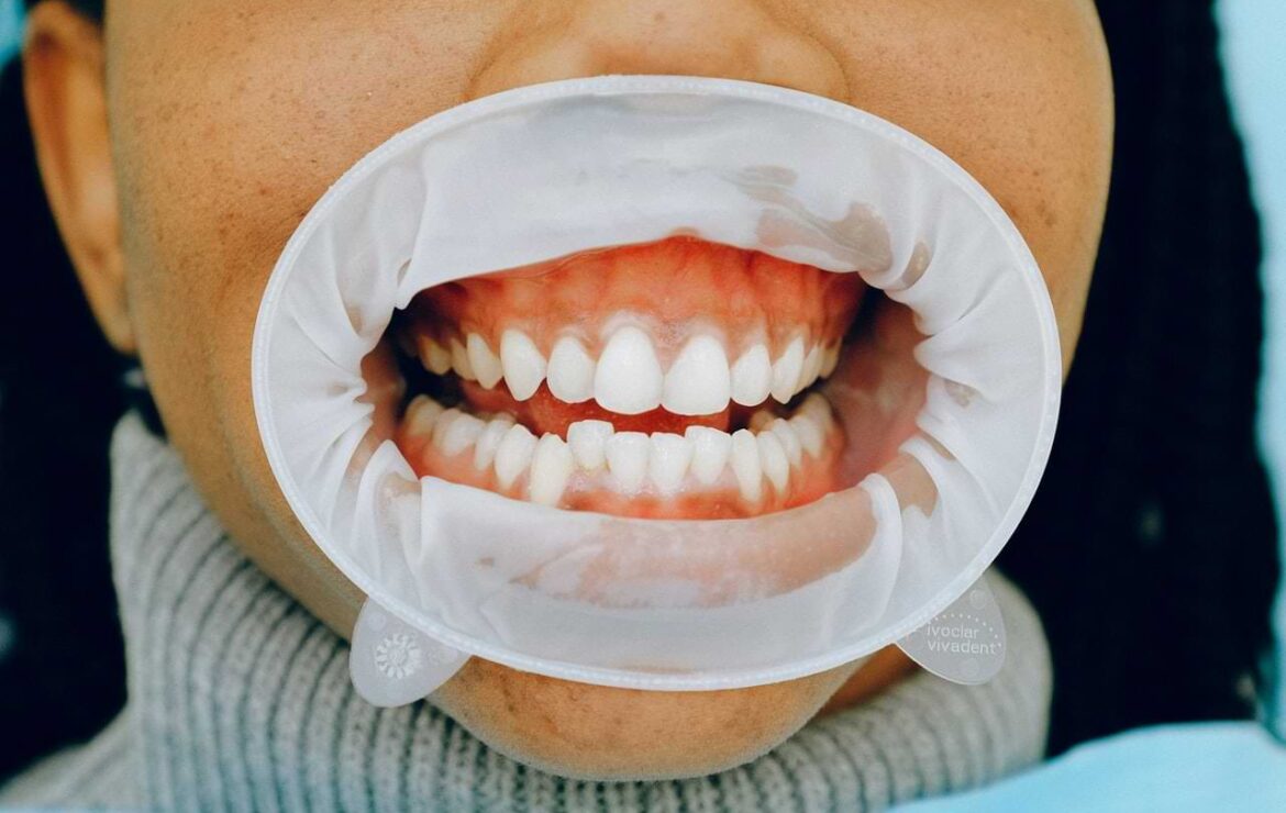 Receding Gums Treatment: What You Need to Know