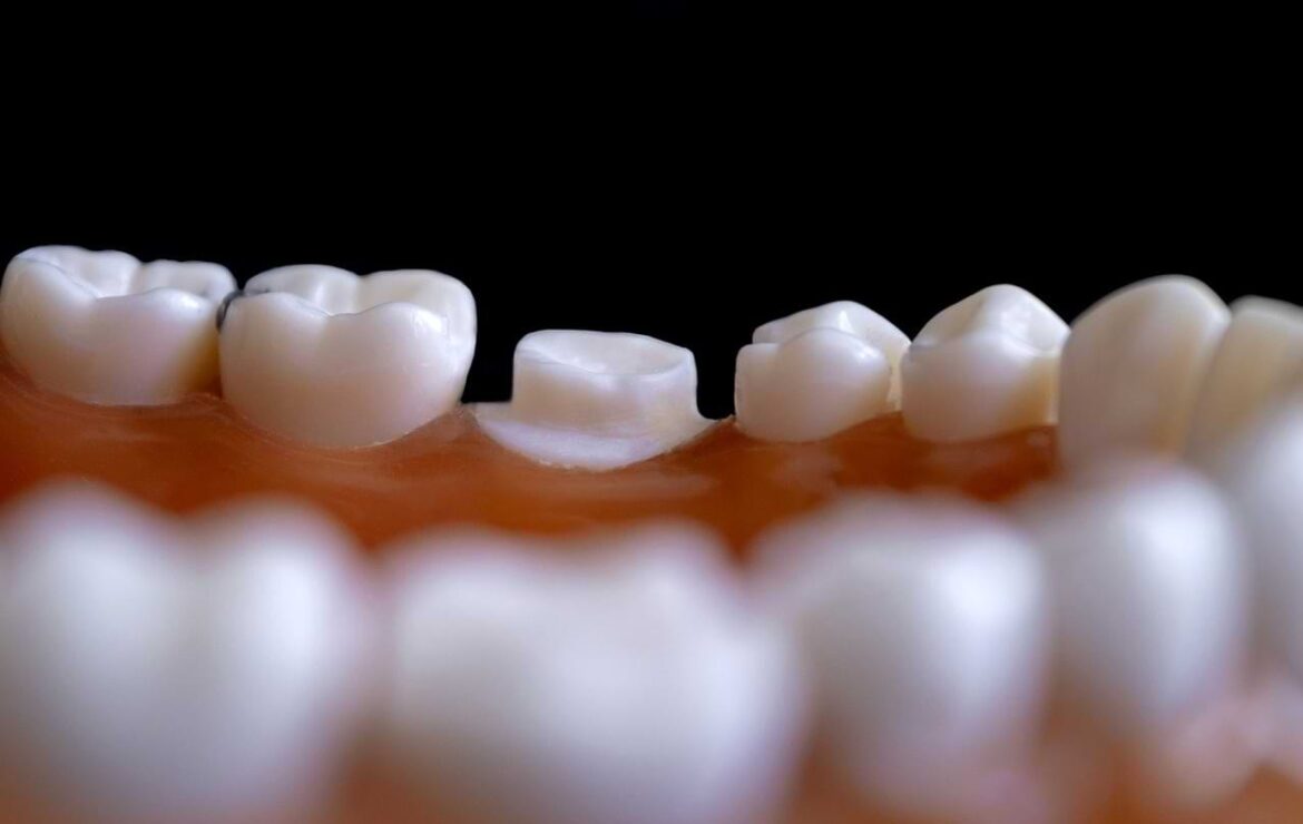 Is a Crown Considered Major Dental Work? Find Out!