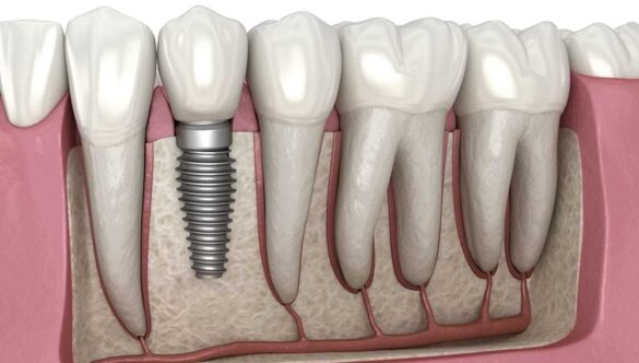 “How Do Dental Implants Work?” & All Your Other Important Dental Implant Questions Answered