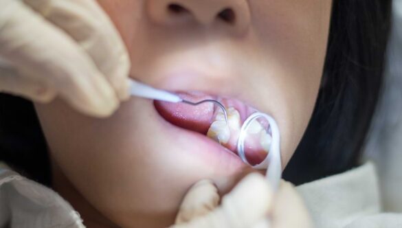 Our Top Tips for a Painless, Stress-Free Root Canal Treatment