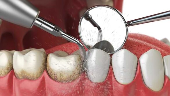 What Happens When You Visit the Dentist for a Clean?
