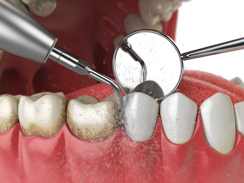 What Happens When You Visit the Dentist for a Clean?