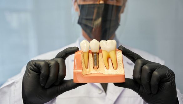 How to Choose the Right Dental Implant Option in Berwick